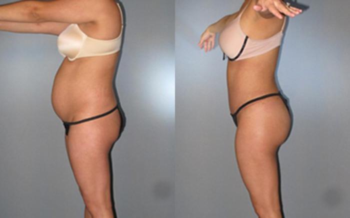Before & After Tummy Tuck Case 7974 View 3 View in Houston, TX