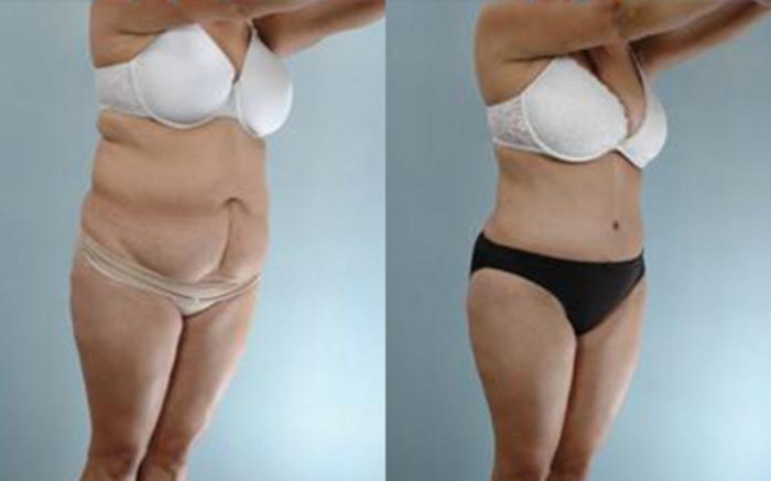 Before & After Tummy Tuck Case 8 View 2 View in Houston, TX