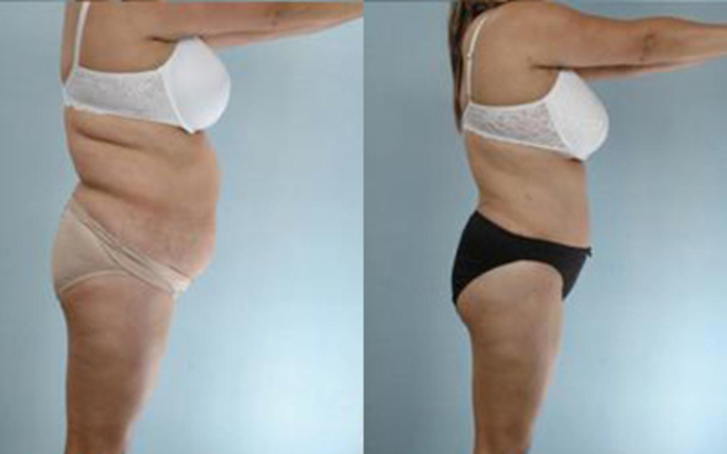 Before & After Tummy Tuck Case 8 View 3 View in Houston, TX