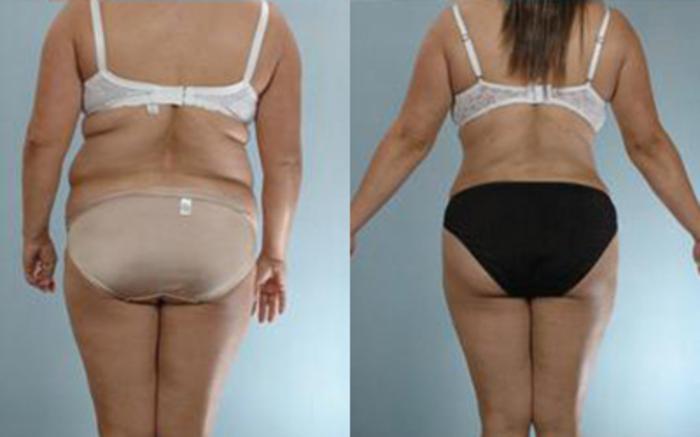Before & After Tummy Tuck Case 8 View 4 View in Houston, TX