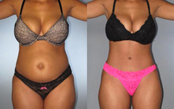 Before & After Tummy Tuck Case 8009 View 1 View in Houston, TX