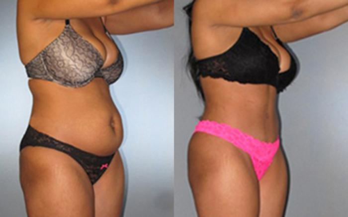 Before & After Tummy Tuck Case 8009 View 2 View in Houston, TX
