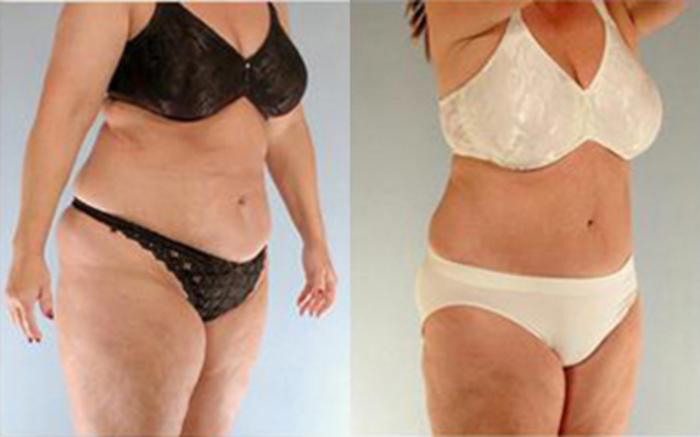 Before & After Tummy Tuck Case 81 View 2 View in Houston, TX