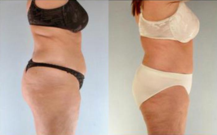Before & After Tummy Tuck Case 81 View 3 View in Houston, TX