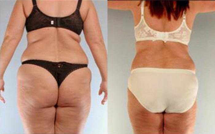 Before & After Tummy Tuck Case 81 View 4 View in Houston, TX