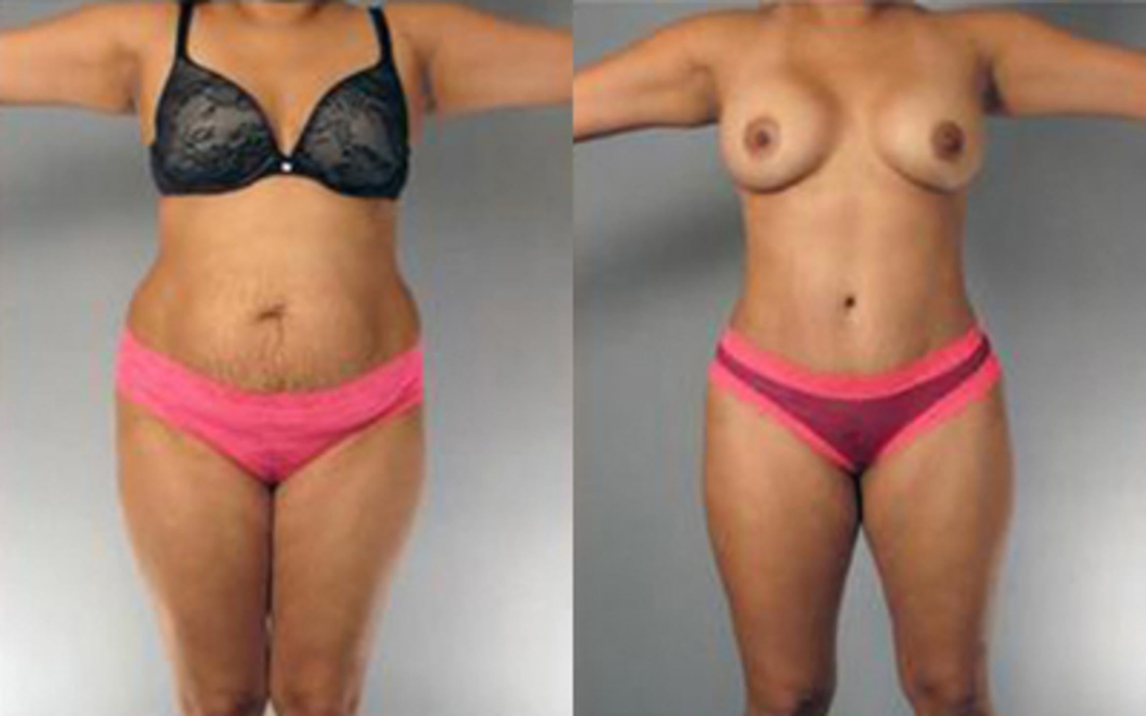 Before & After Tummy Tuck Case 82 View 1 View in Houston, TX