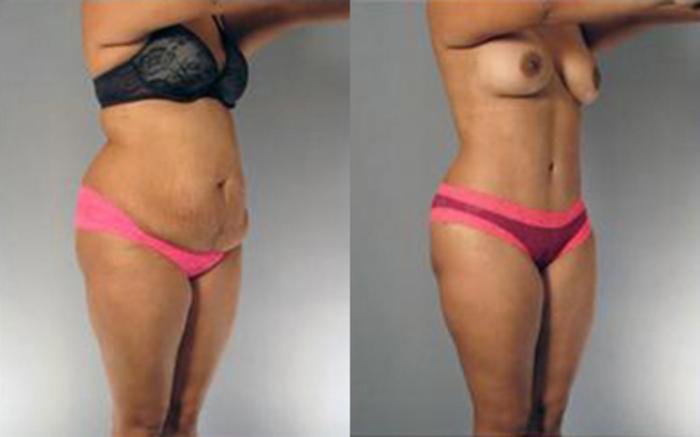 Before & After Tummy Tuck Case 82 View 2 View in Houston, TX