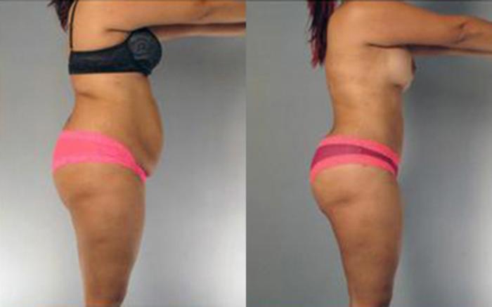 Before & After Tummy Tuck Case 82 View 3 View in Houston, TX