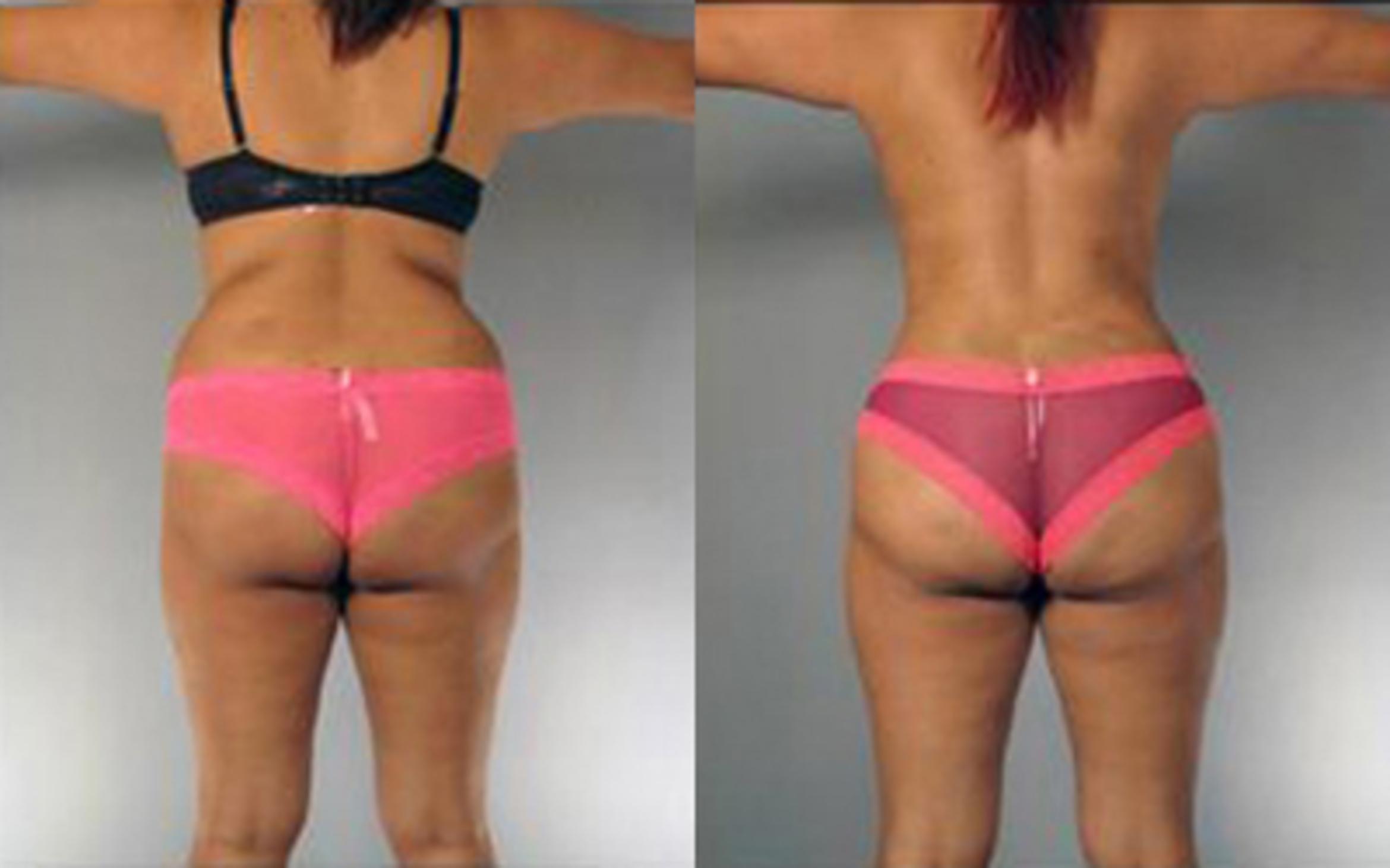 Before & After Tummy Tuck Case 82 View 4 View in Houston, TX