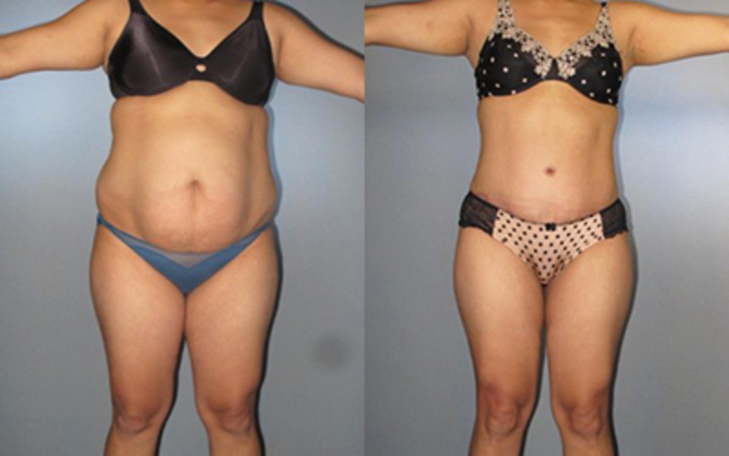 Before & After Tummy Tuck Case 8273 View 1 View in Houston, TX