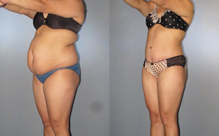 Before & After Tummy Tuck Case 8273 View 2 View in Houston, TX
