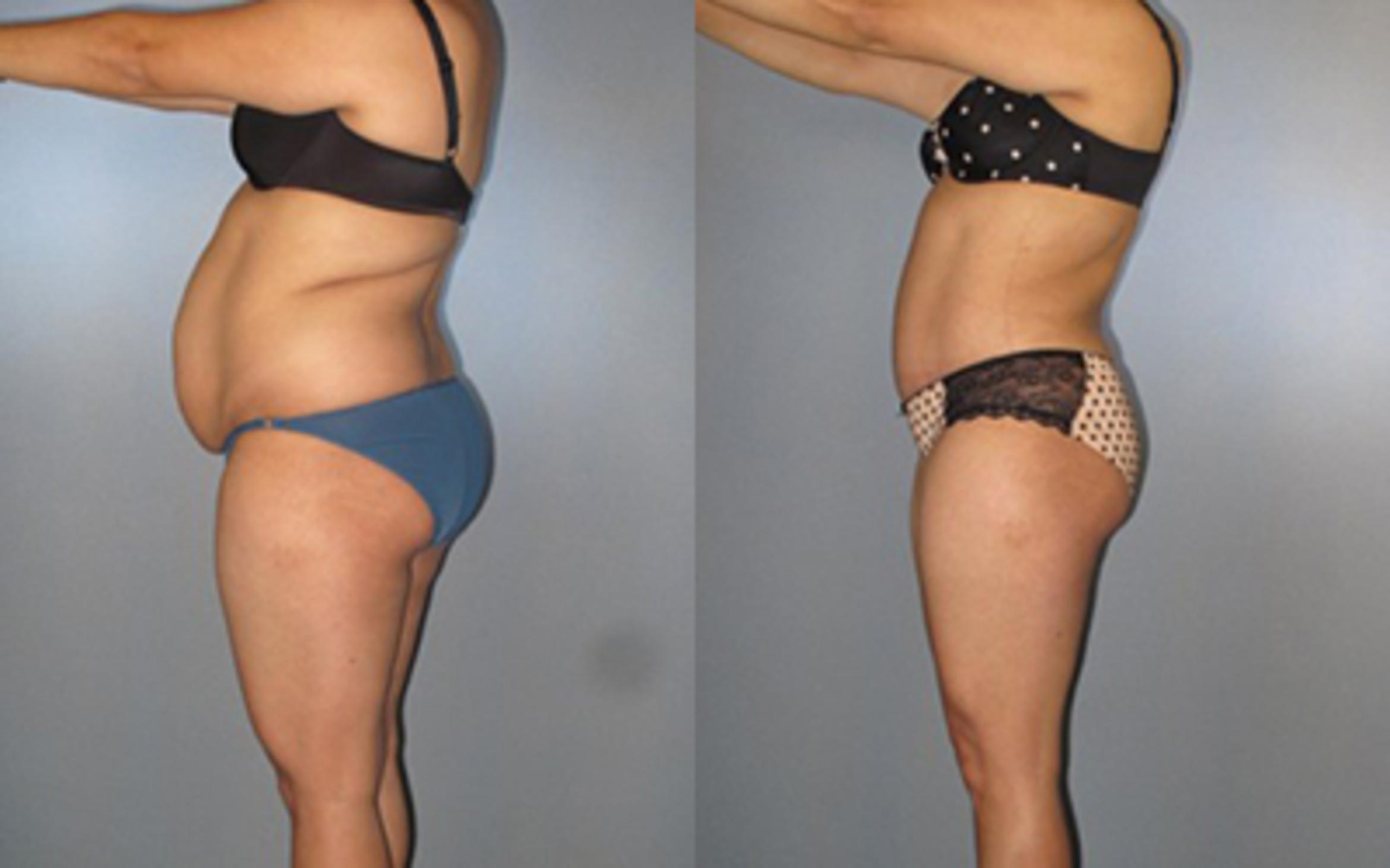 Before & After Tummy Tuck Case 8273 View 3 View in Houston, TX