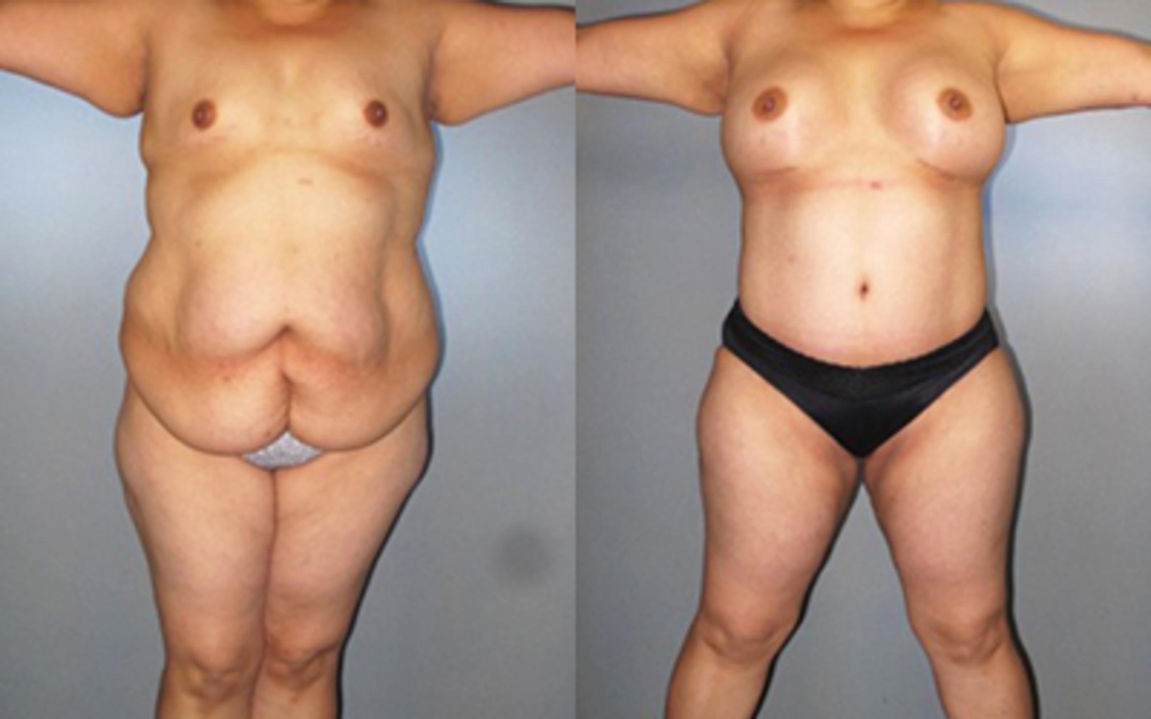 Before & After Tummy Tuck Case 8289 View 1 View in Houston, TX