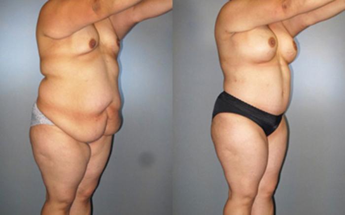 Before & After Tummy Tuck Case 8289 View 2 View in Houston, TX