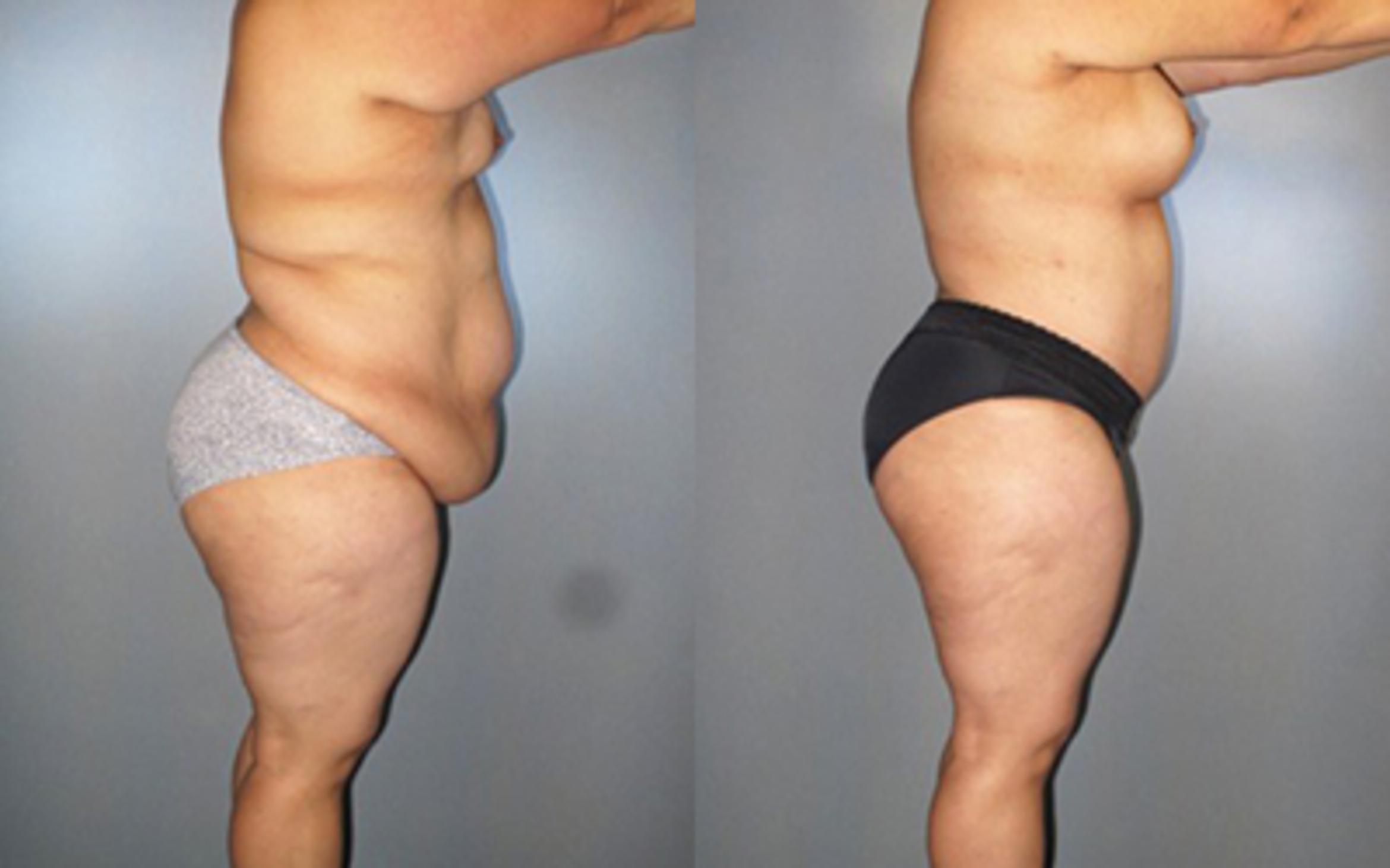 Before & After Tummy Tuck Case 8289 View 3 View in Houston, TX