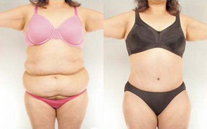 Before & After Tummy Tuck Case 83 View 1 View in Houston, TX