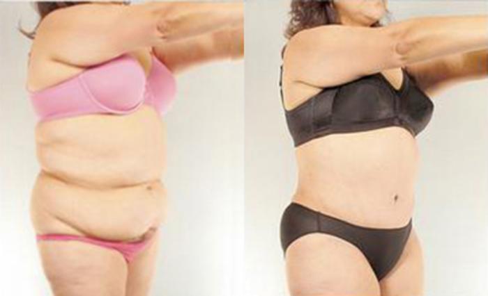 Before & After Tummy Tuck Case 83 View 2 View in Houston, TX
