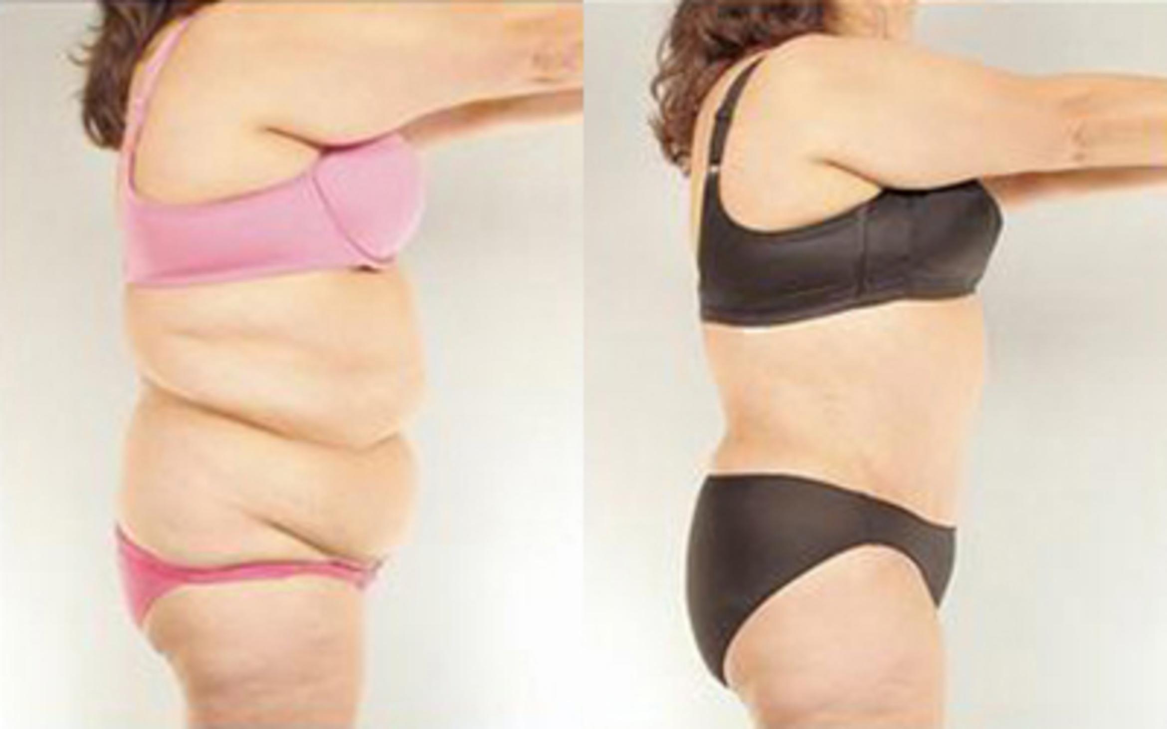 Before & After Tummy Tuck Case 83 View 3 View in Houston, TX