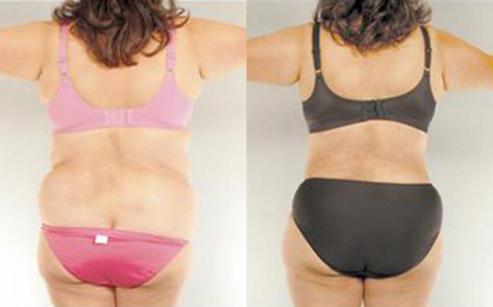 Before & After Tummy Tuck Case 83 View 4 View in Houston, TX