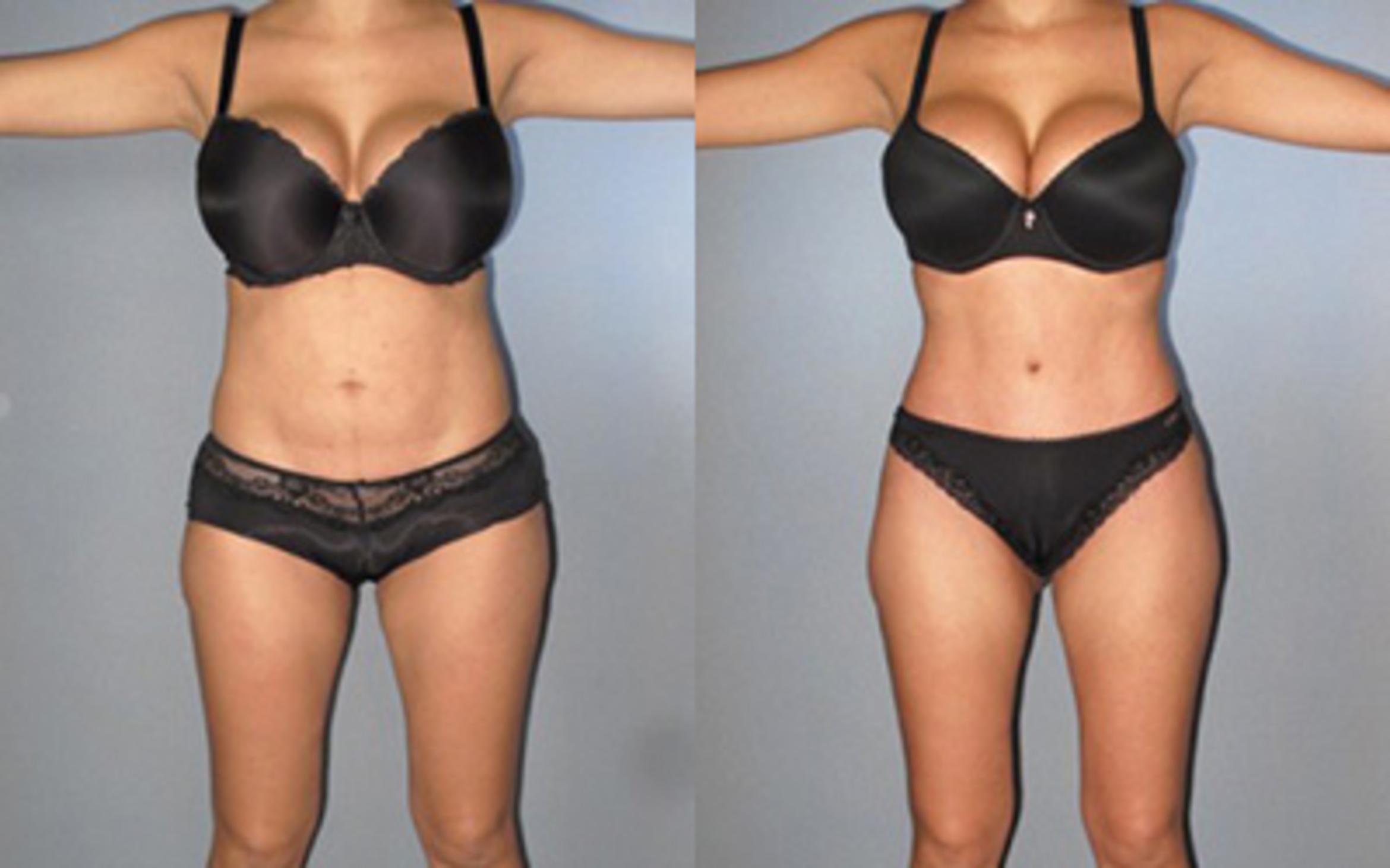 Before & After Tummy Tuck Case 8368 View 1 View in Houston, TX