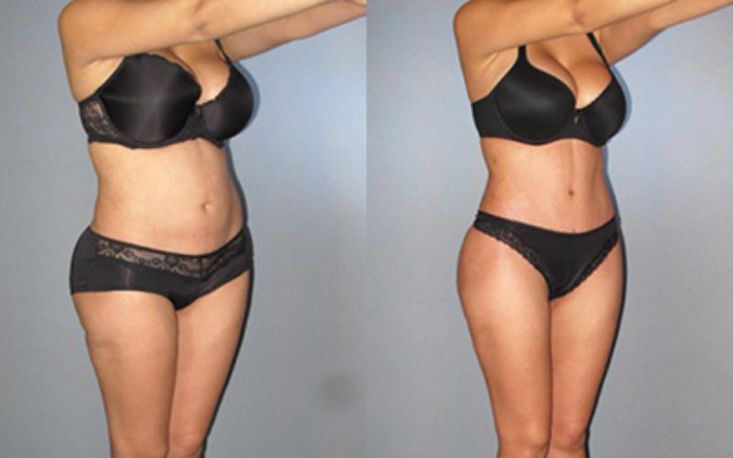 Before & After Tummy Tuck Case 8368 View 2 View in Houston, TX
