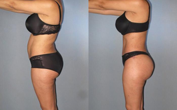 Before & After Tummy Tuck Case 8368 View 3 View in Houston, TX