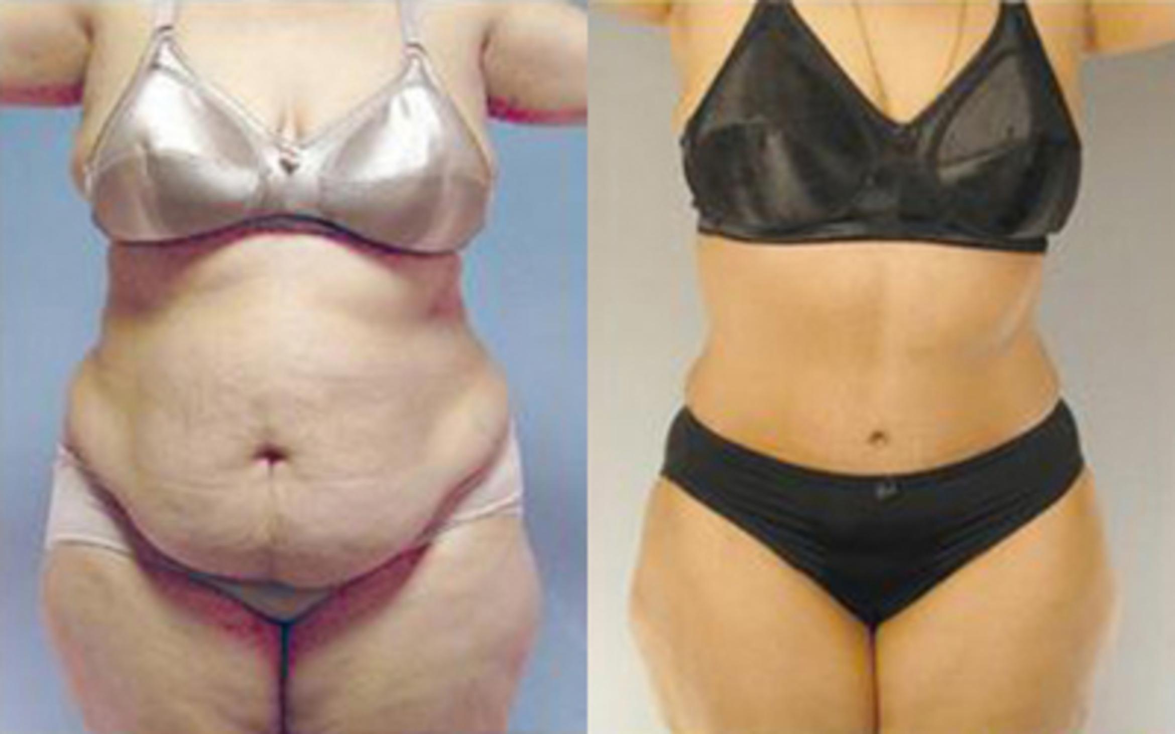 Before & After Tummy Tuck Case 84 View 1 View in Houston, TX