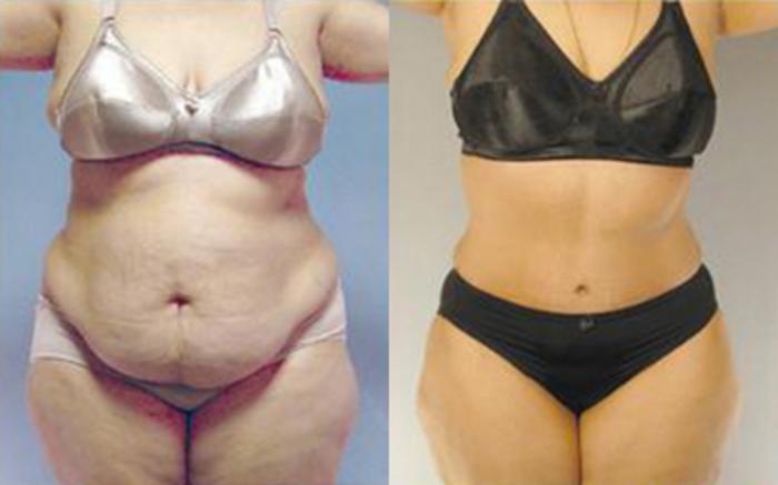 Before & After Tummy Tuck Case 84 View 1 View in Houston, TX