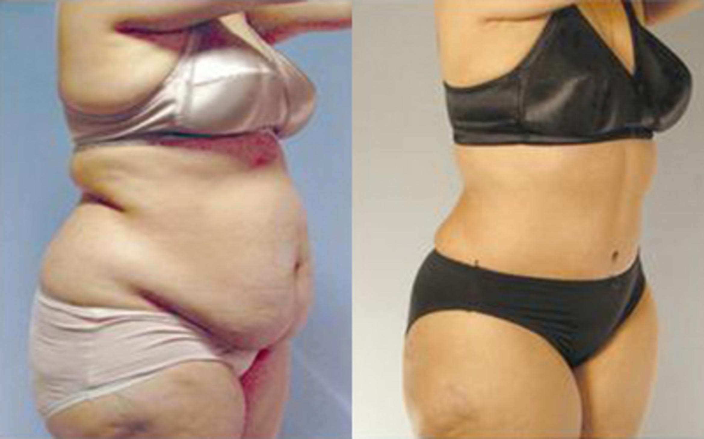 Before & After Tummy Tuck Case 84 View 2 View in Houston, TX