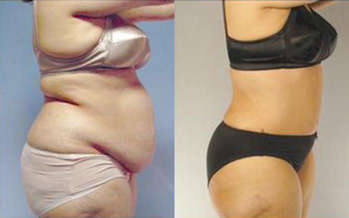 Before & After Tummy Tuck Case 84 View 3 View in Houston, TX