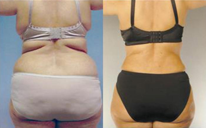 Before & After Tummy Tuck Case 84 View 4 View in Houston, TX