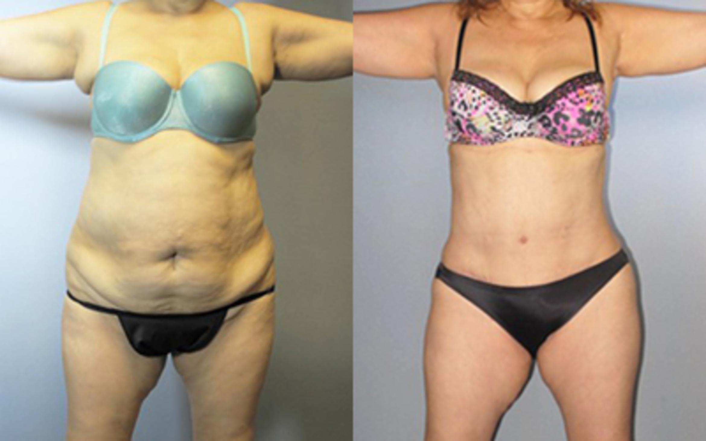 Before & After Tummy Tuck Case 85669999 View 1 View in Houston, TX