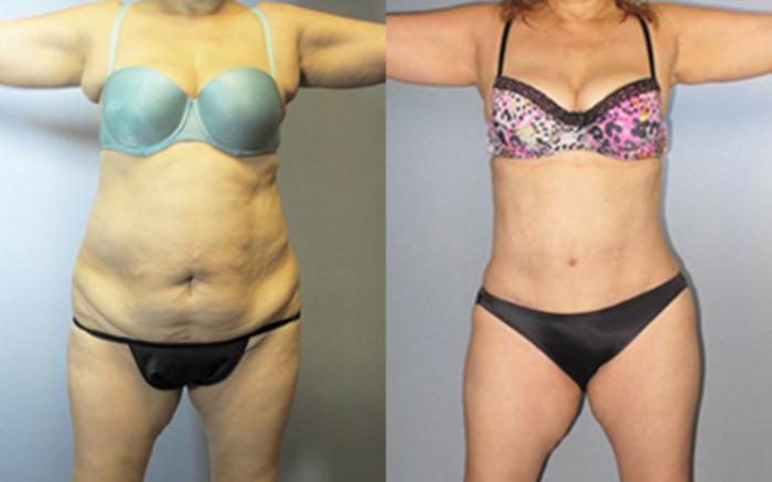 Before & After Tummy Tuck Case 85669999 View 1 View in Houston, TX