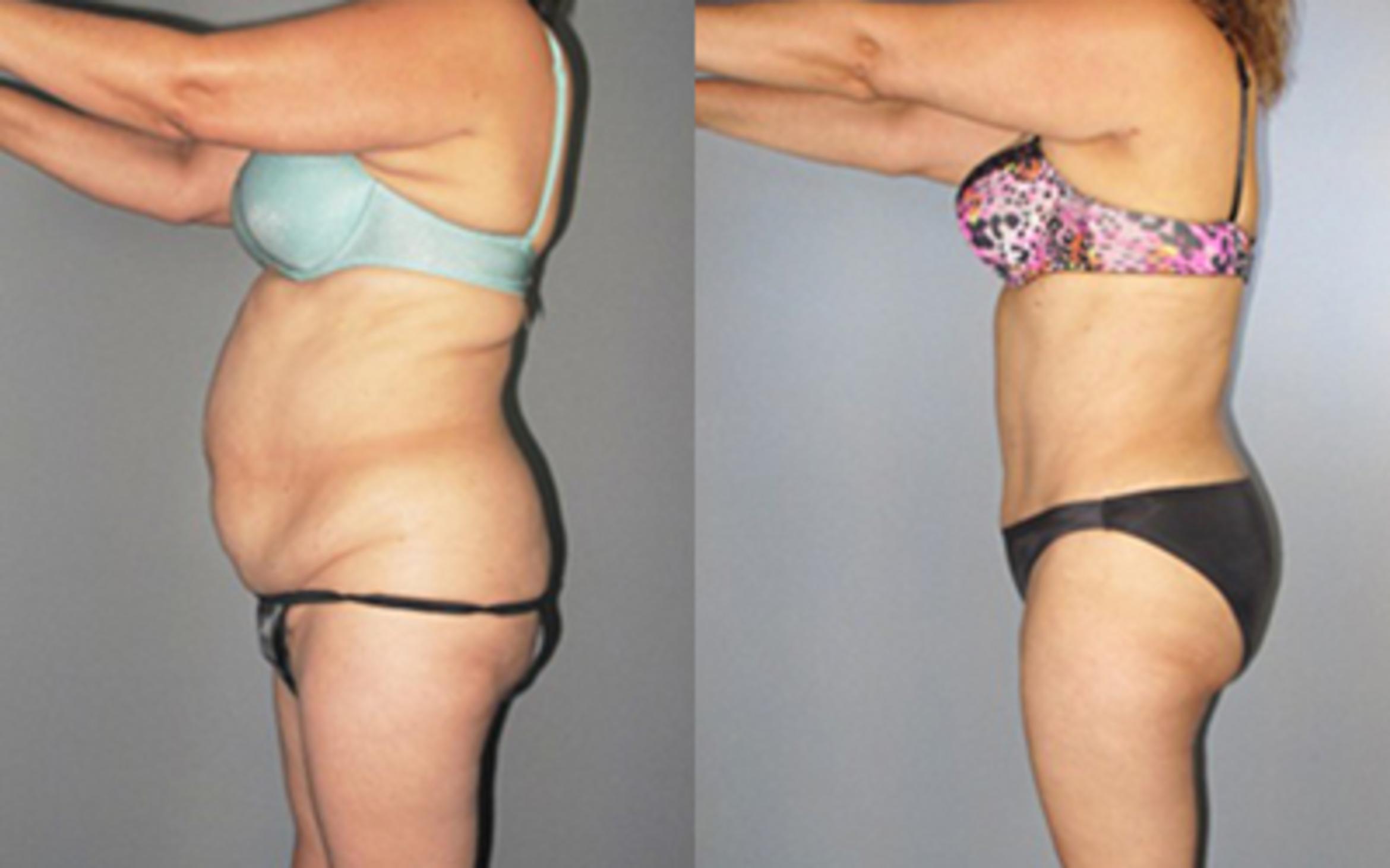 Before & After Tummy Tuck Case 85669999 View 2 View in Houston, TX