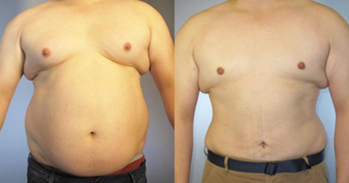 Before & After Tummy Tuck Case 8701 View 1 View in Houston, TX