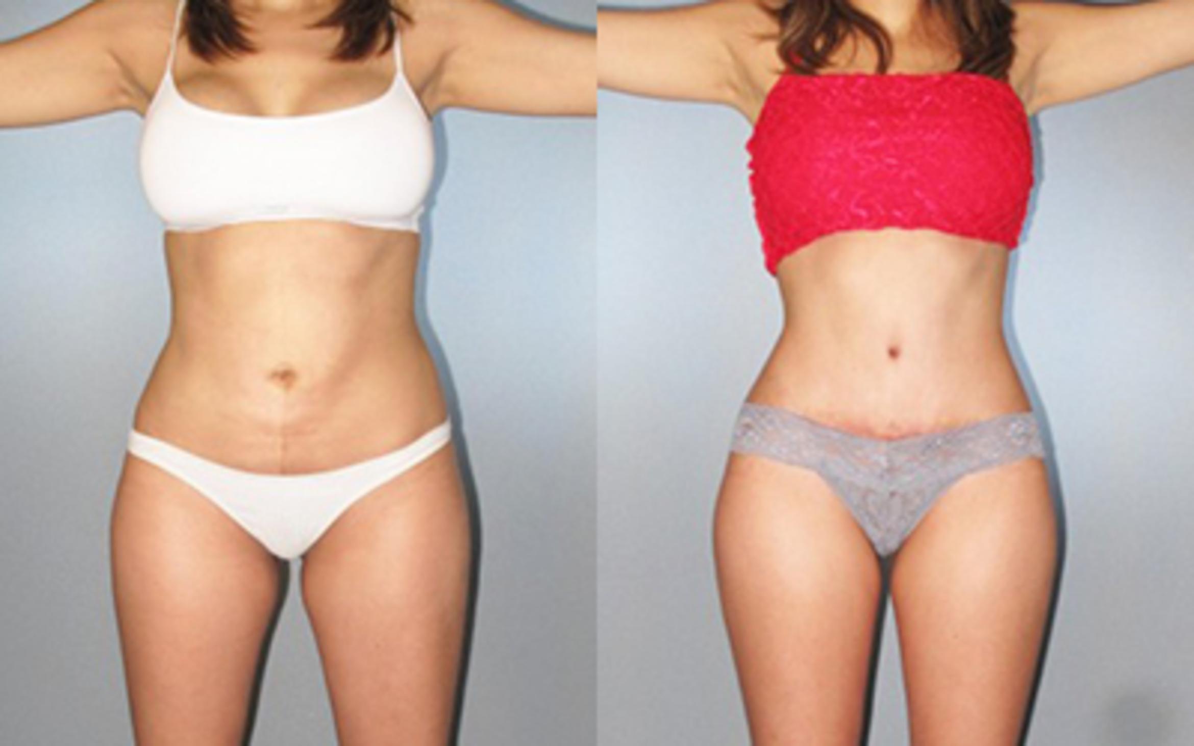 Before & After Tummy Tuck Case 8716 View 1 View in Houston, TX