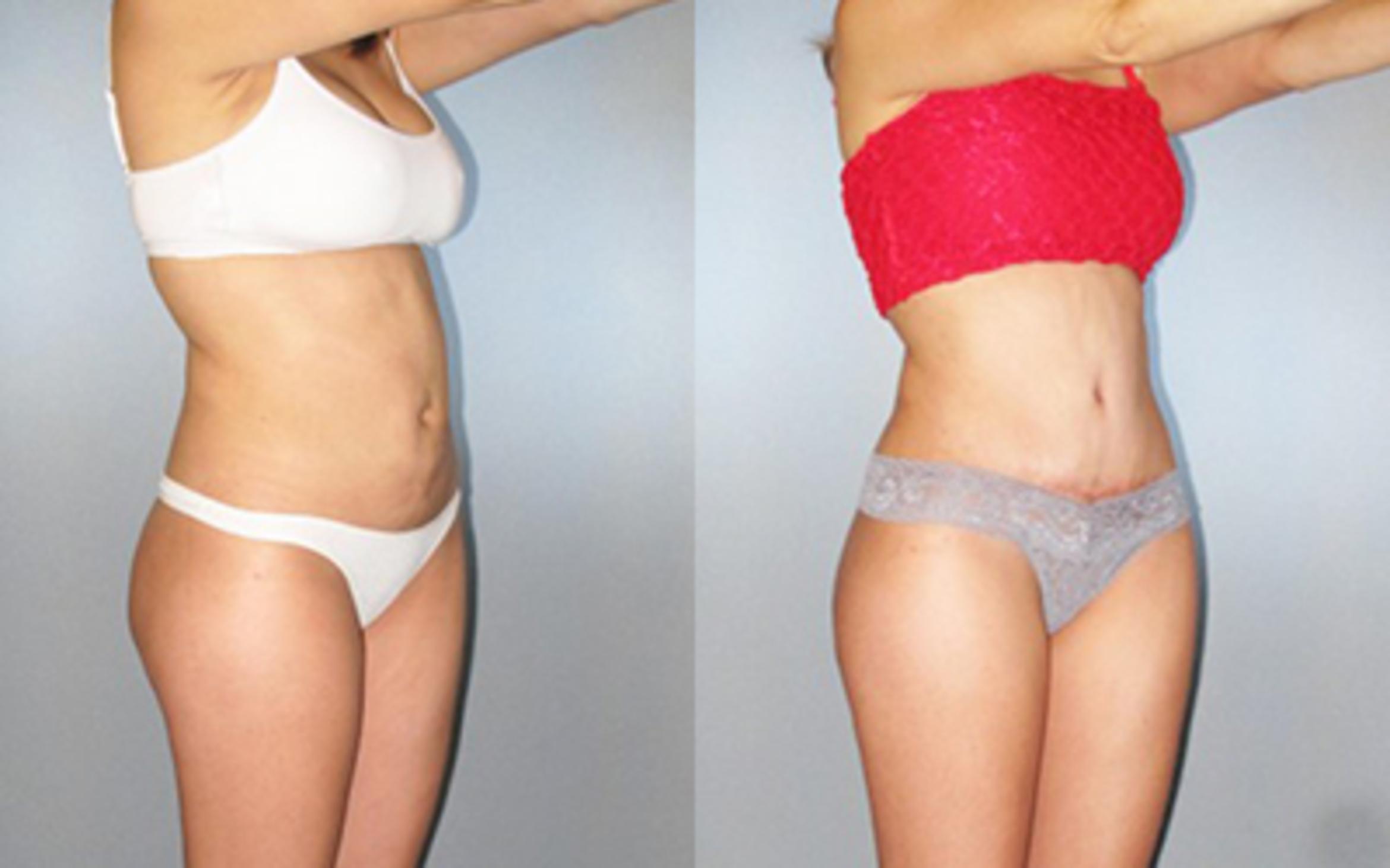 Before & After Tummy Tuck Case 8716 View 2 View in Houston, TX