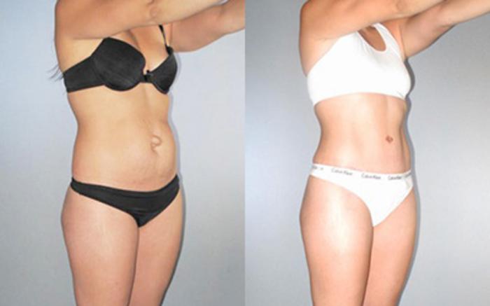 Before & After Tummy Tuck Case 8921 View 1 View in Houston, TX