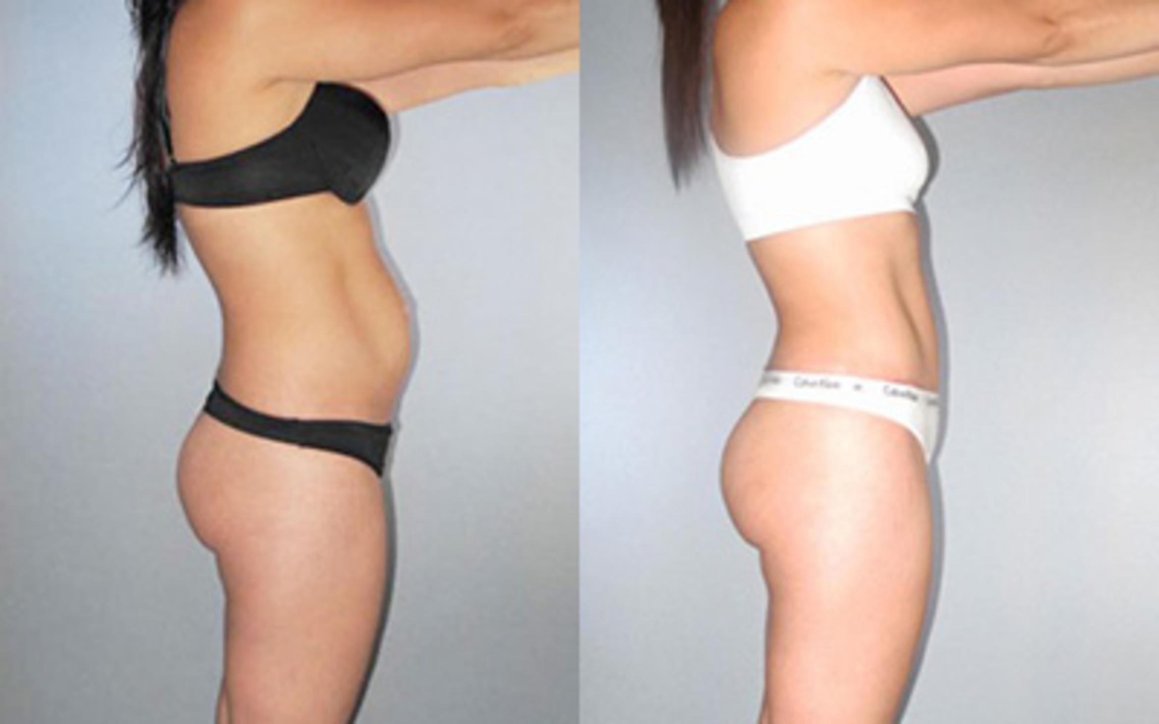 Before & After Tummy Tuck Case 8921 View 2 View in Houston, TX