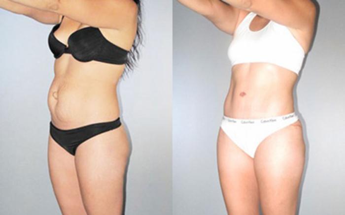 Before & After Tummy Tuck Case 8921 View 3 View in Houston, TX