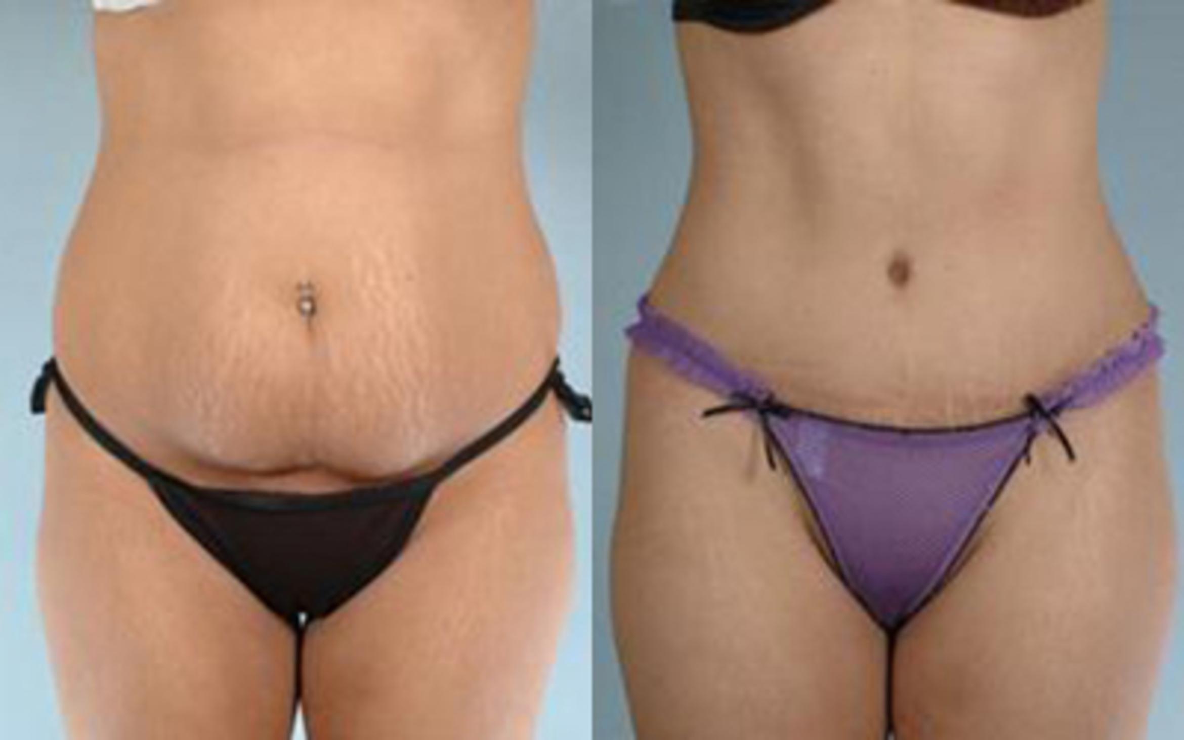 Before & After Tummy Tuck Case 9 View 1 View in Houston, TX