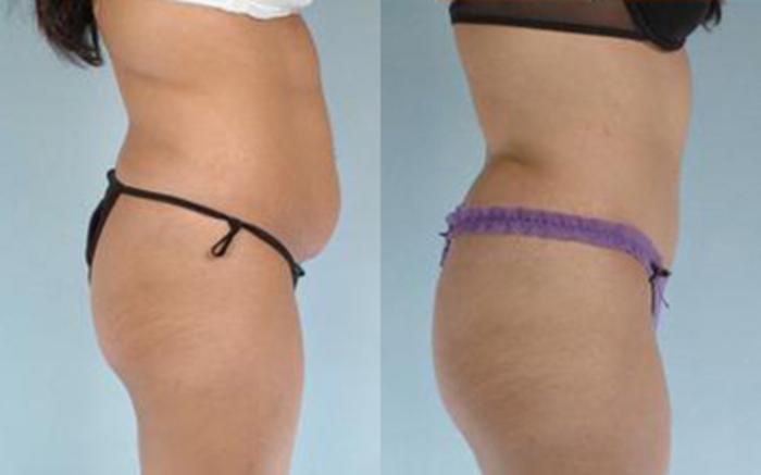 Before & After Tummy Tuck Case 9 View 3 View in Houston, TX