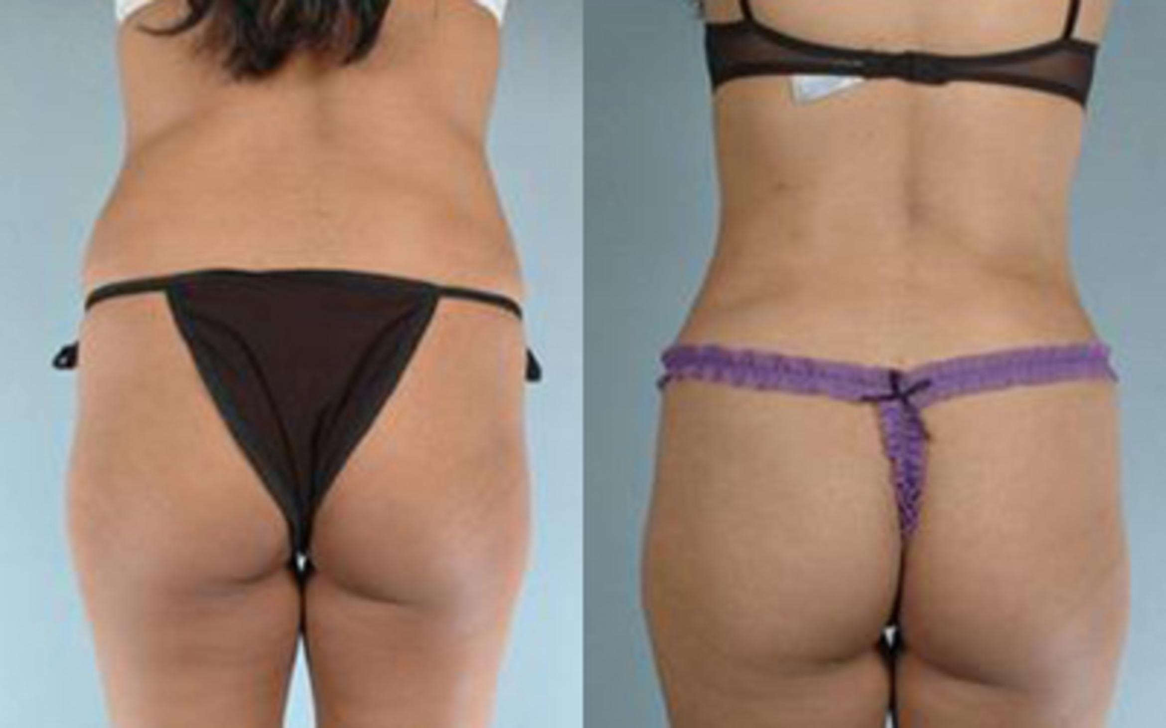 Before & After Tummy Tuck Case 9 View 4 View in Houston, TX