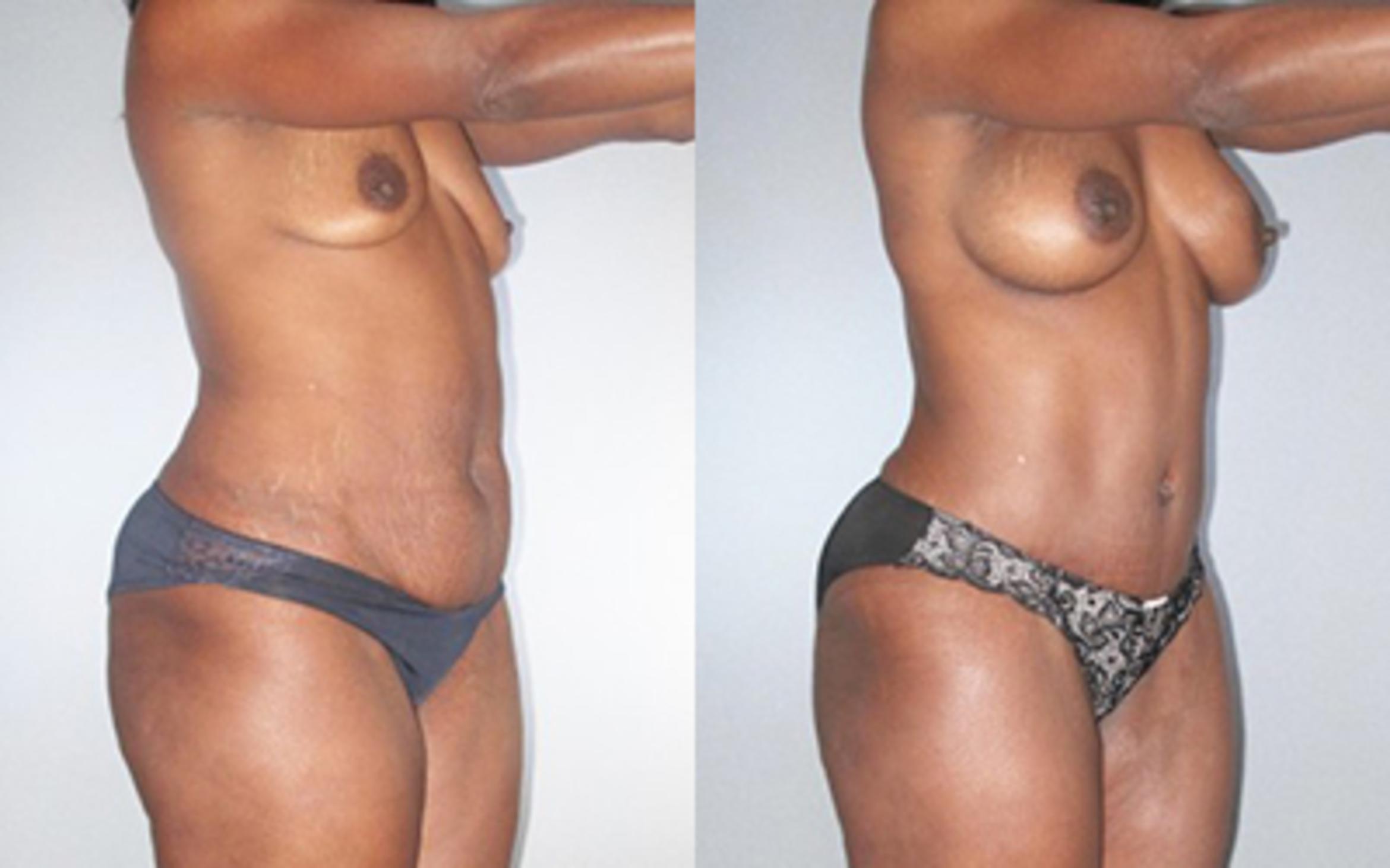 Before & After Tummy Tuck Case 9251 View 2 View in Houston, TX