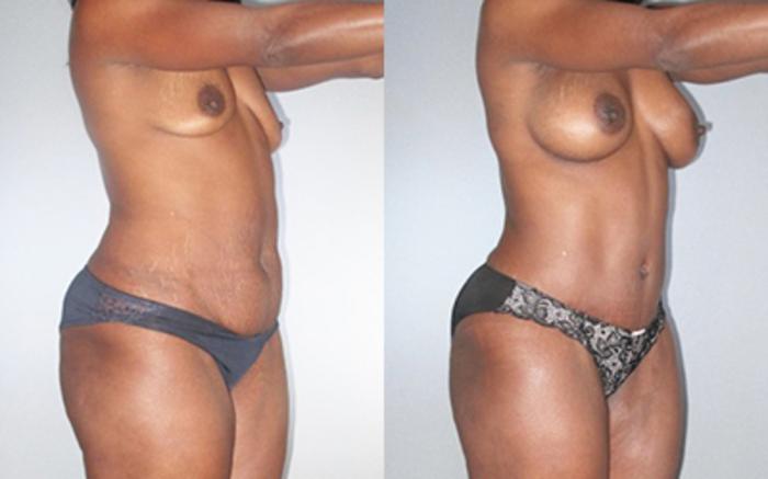 Before & After Tummy Tuck Case 9251 View 2 View in Houston, TX