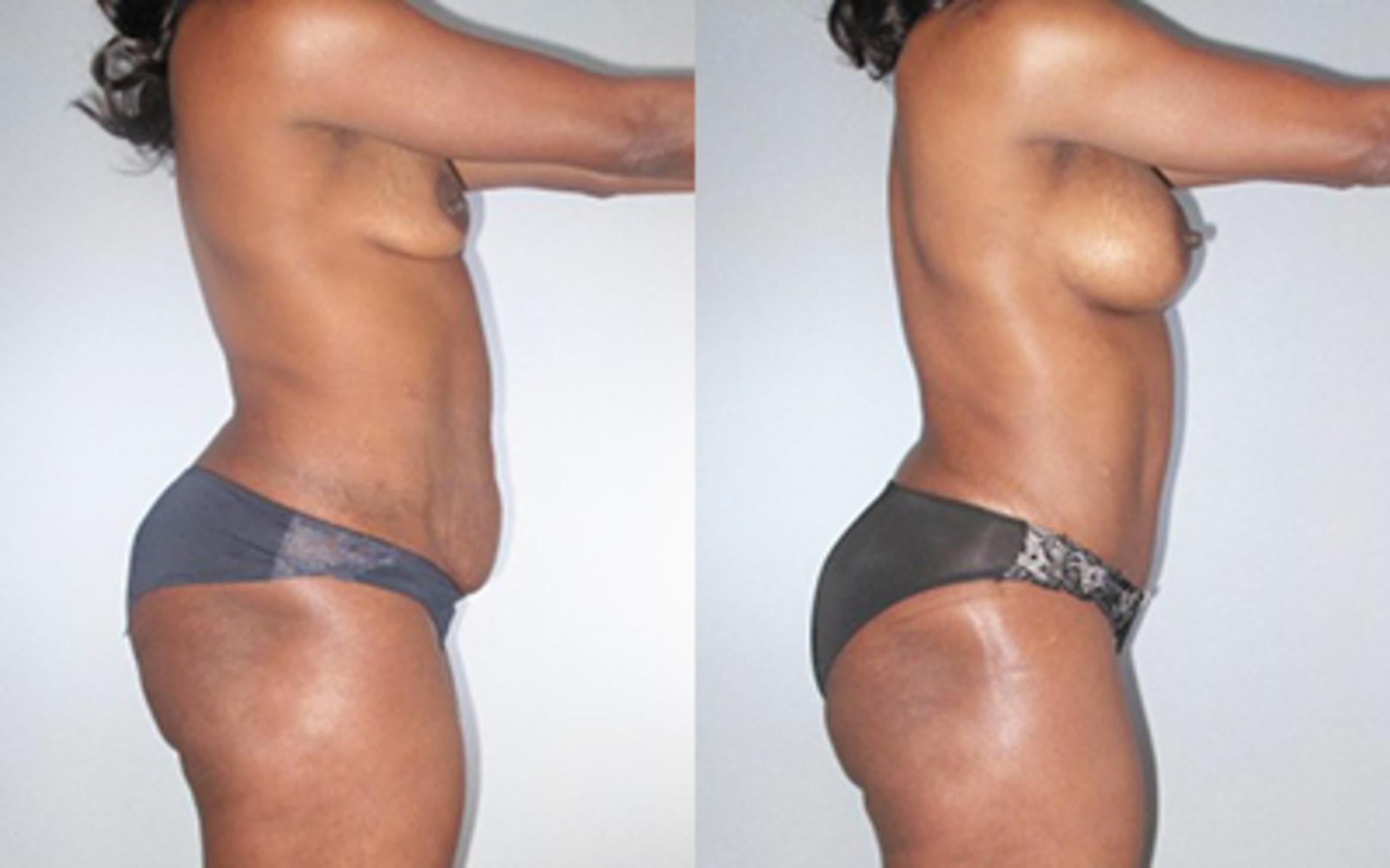 Before & After Tummy Tuck Case 9251 View 3 View in Houston, TX