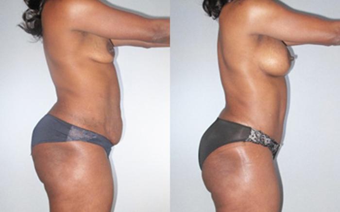 Before & After Tummy Tuck Case 9251 View 3 View in Houston, TX