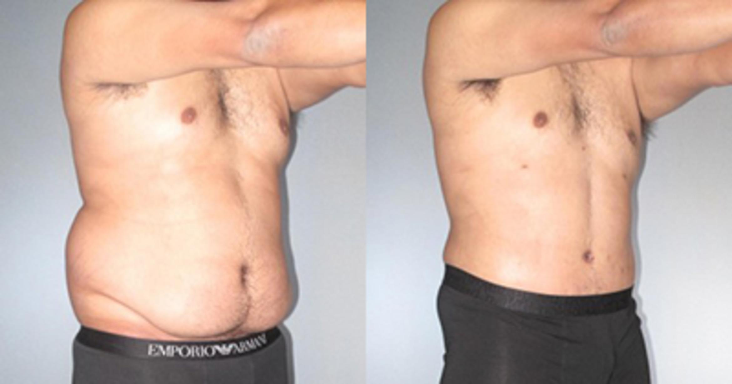 Before & After Tummy Tuck Case 9270 View 2 View in Houston, TX