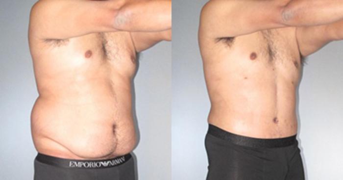 Before & After Tummy Tuck Case 9270 View 2 View in Houston, TX