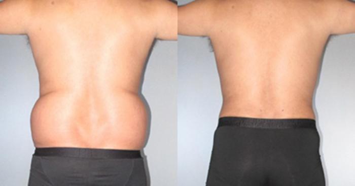Before & After Tummy Tuck Case 9270 View 3 View in Houston, TX